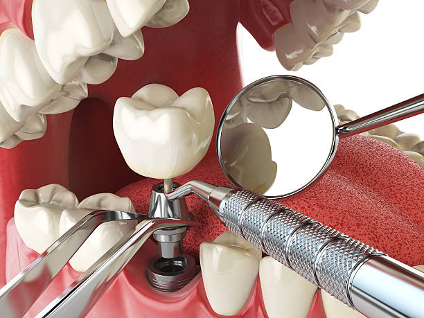 Best Cracked Tooth Emergency Dentist  in Valley Springs, CA
